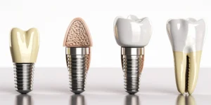 Implanty zębów cała szczęka cena Warszawa